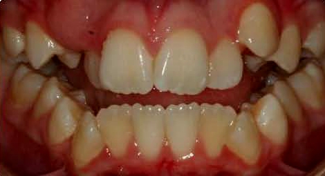 open bite before braces open bite before braces