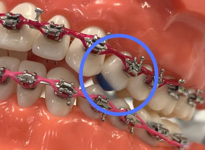 bite pad example - close teeth