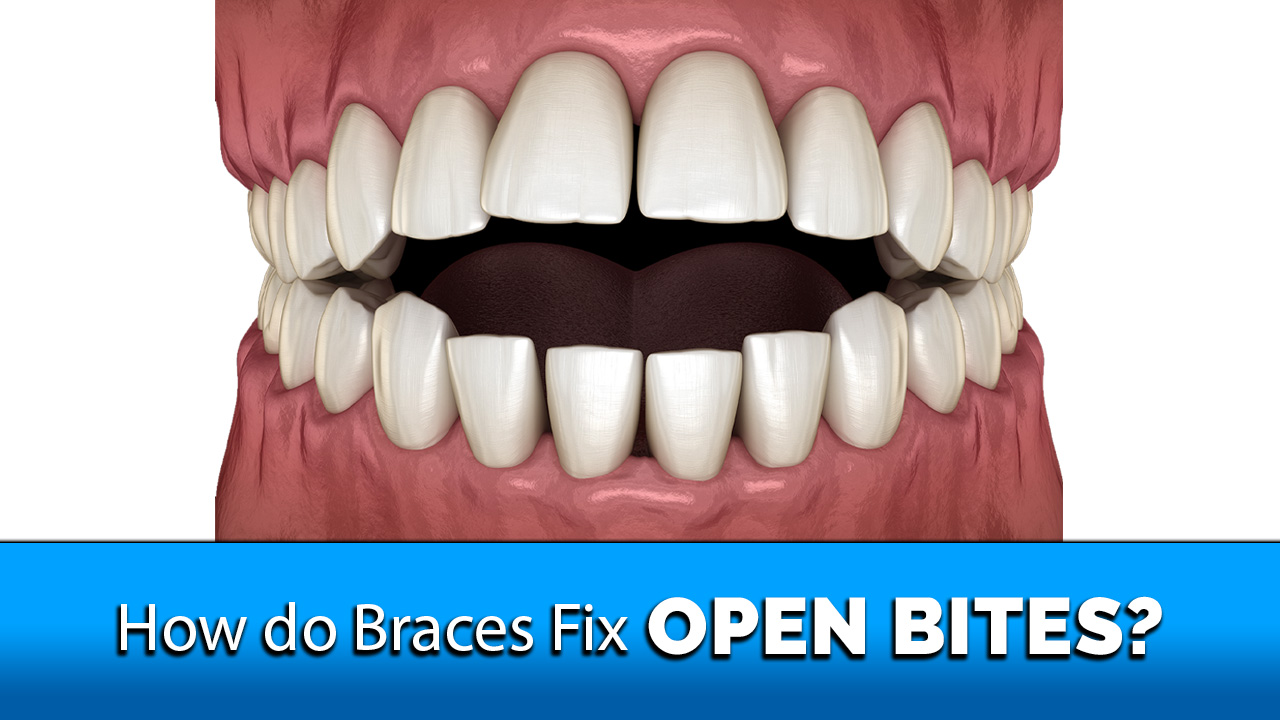 how do braces fix open bites