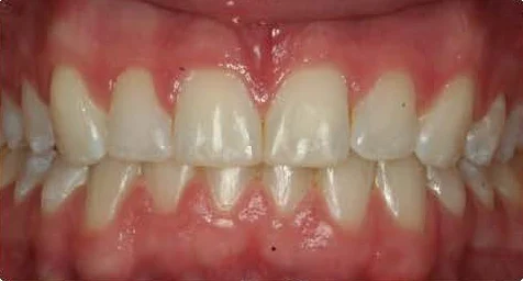 ideal overbite example