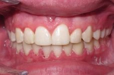 mild deep bite example teeth image after