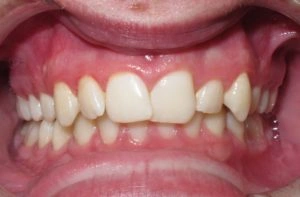 mild deep bite example teeth image