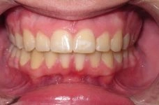 moderate deep bite example teeth after