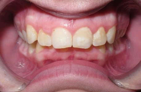 moderate deep bite example teeth before