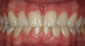 severe deep bite example teeth after