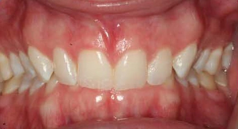 severe deep bite example teeth before