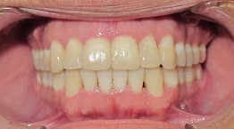 Anterior Crossbite Braces and Bite Pads