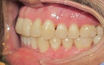 Anterior Crossbite after Braces and Bite Pads