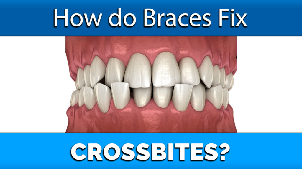 how do braces fix crossbites