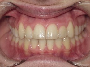 anterior and posterior crossbite after