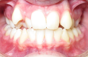 anterior and posterior crossbite before braces