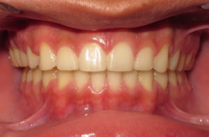 buccal crossbite after braces