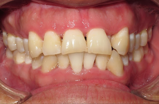 single-tooth anterior crossbite