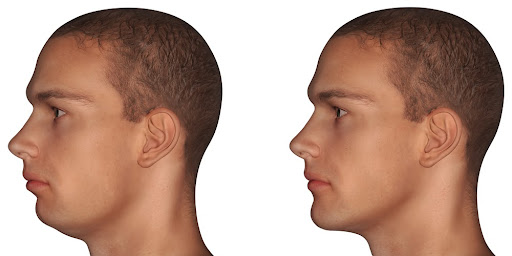 An example of an improved profile due to jaw surgery