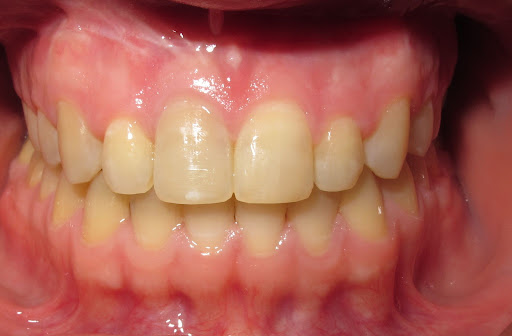 maxillary advancement due to a retrusive upper jaw