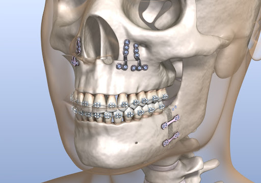 Jaw surgery is performed by an oral surgeon