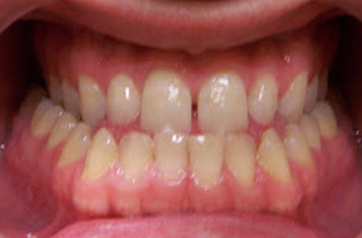 maxillary advancement due to a retrusive upper jaw