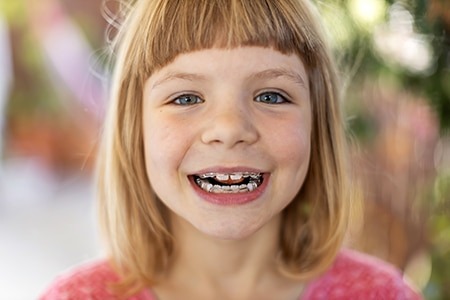 Phase 1 Braces Treatment