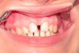 gap from expander