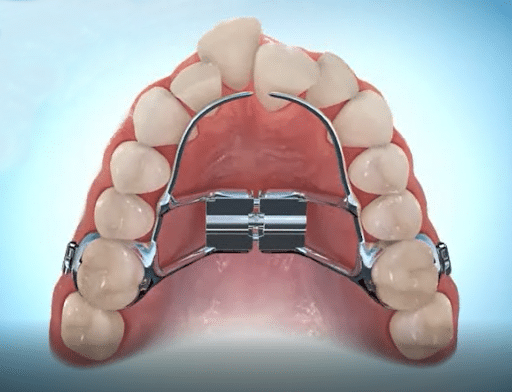 The Complete Guide to Palate Expanders and Braces