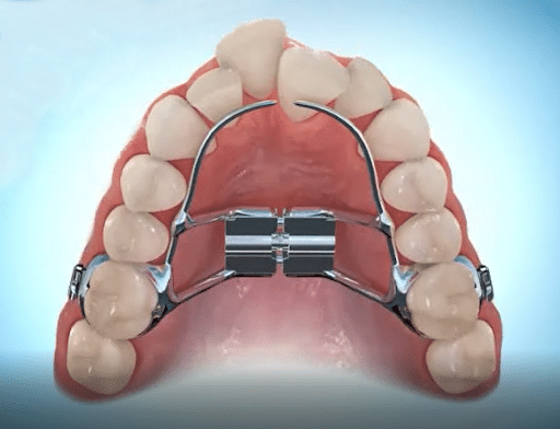 palate expander