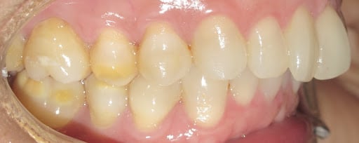 adult braces overbite before lateral