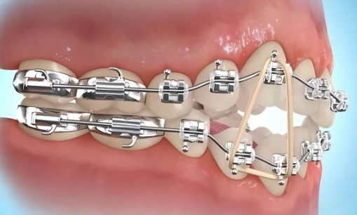 How to put rubber bands on braces for open bites