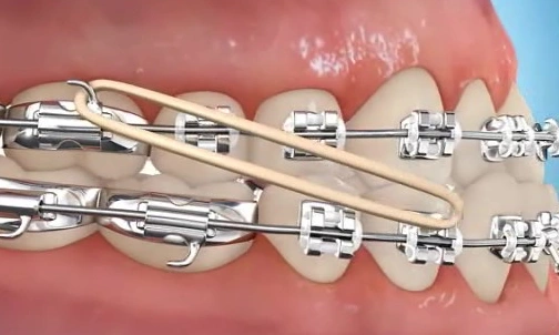How to put rubber bands on braces for underbites