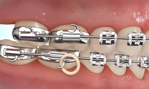 elastics attach to the tiny hook on the lower tooth