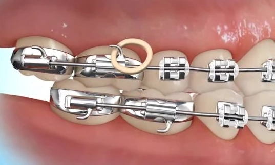 elastics attach to the tiny hook on the top tooth and onto the tiny hook on the bottom tooth