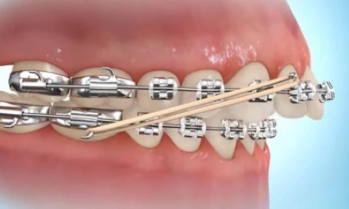 elastics hook from the bottom tooth to the top tooth