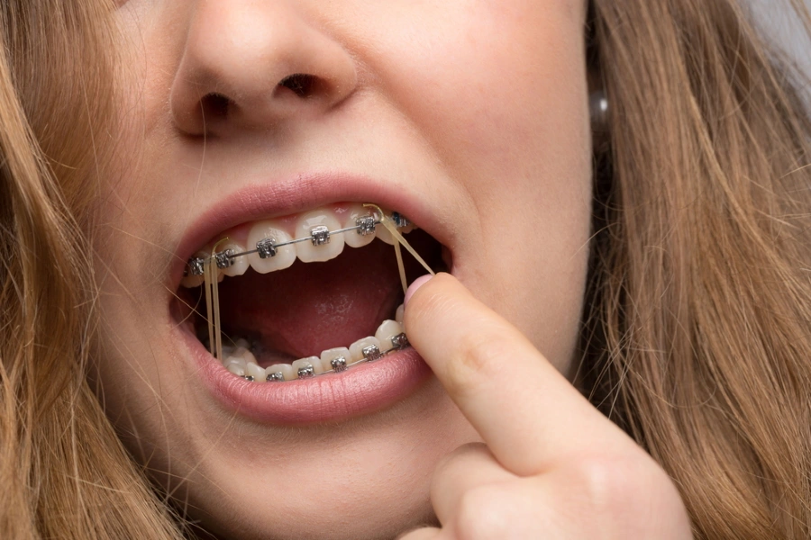 how to put rubber bands on braces with fingers