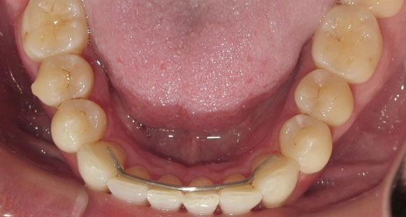 Mild Braces Case After 2