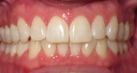 Mild Braces Case Before 1