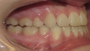 Severe Braces Case After 1