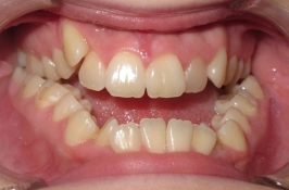 Severe Braces Case Before 2