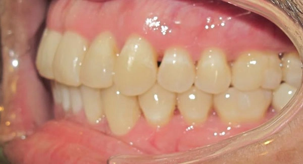 Severe Braces Case After 2