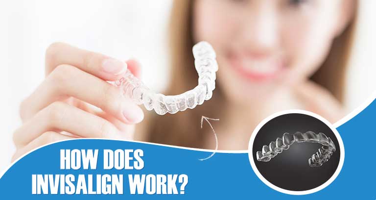 How Does Invisalign Work