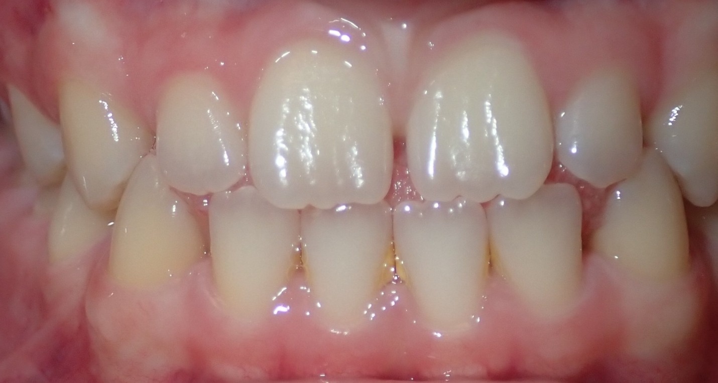 Before