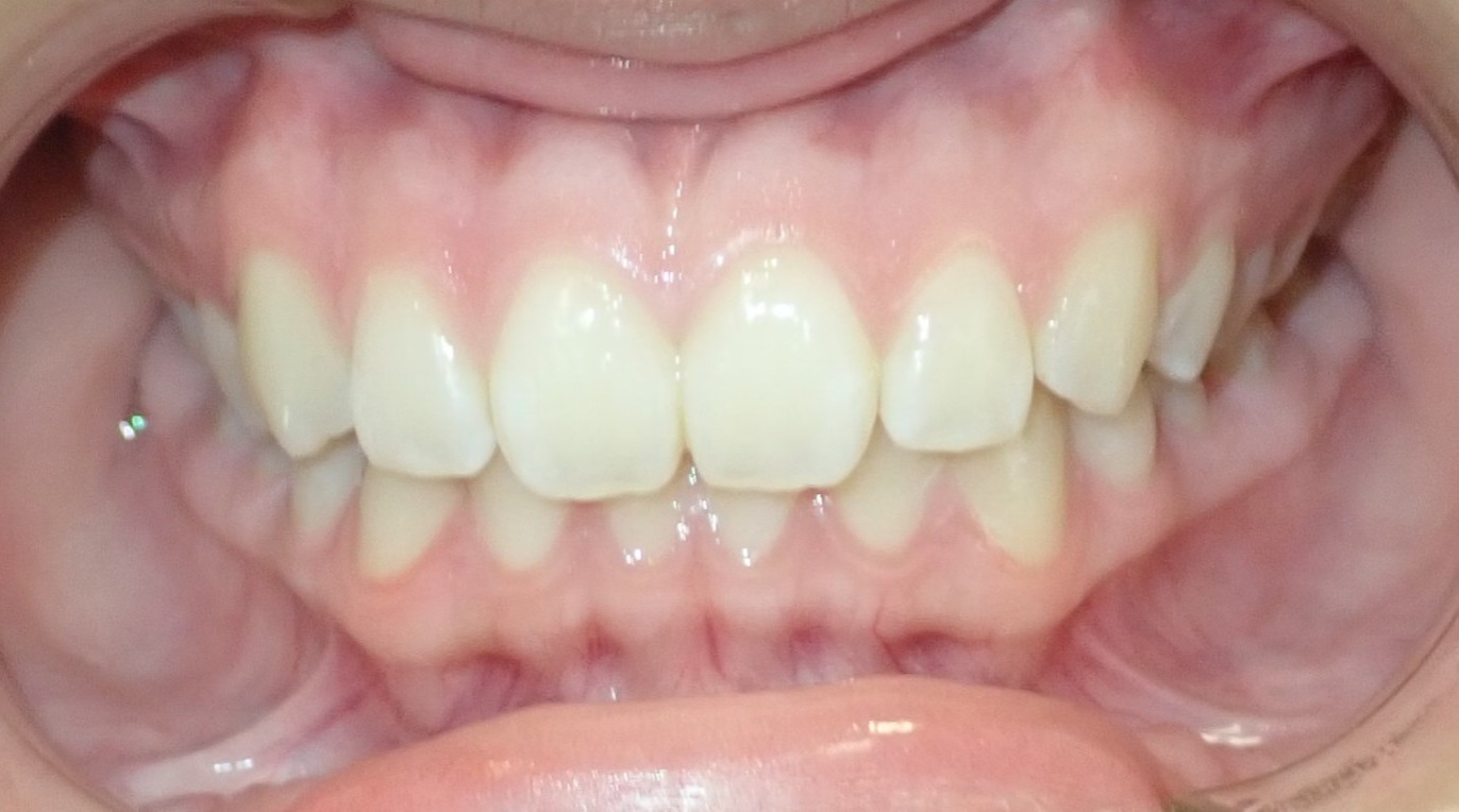 Before