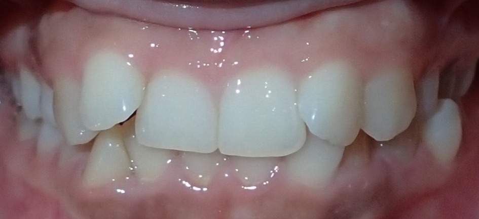 Before