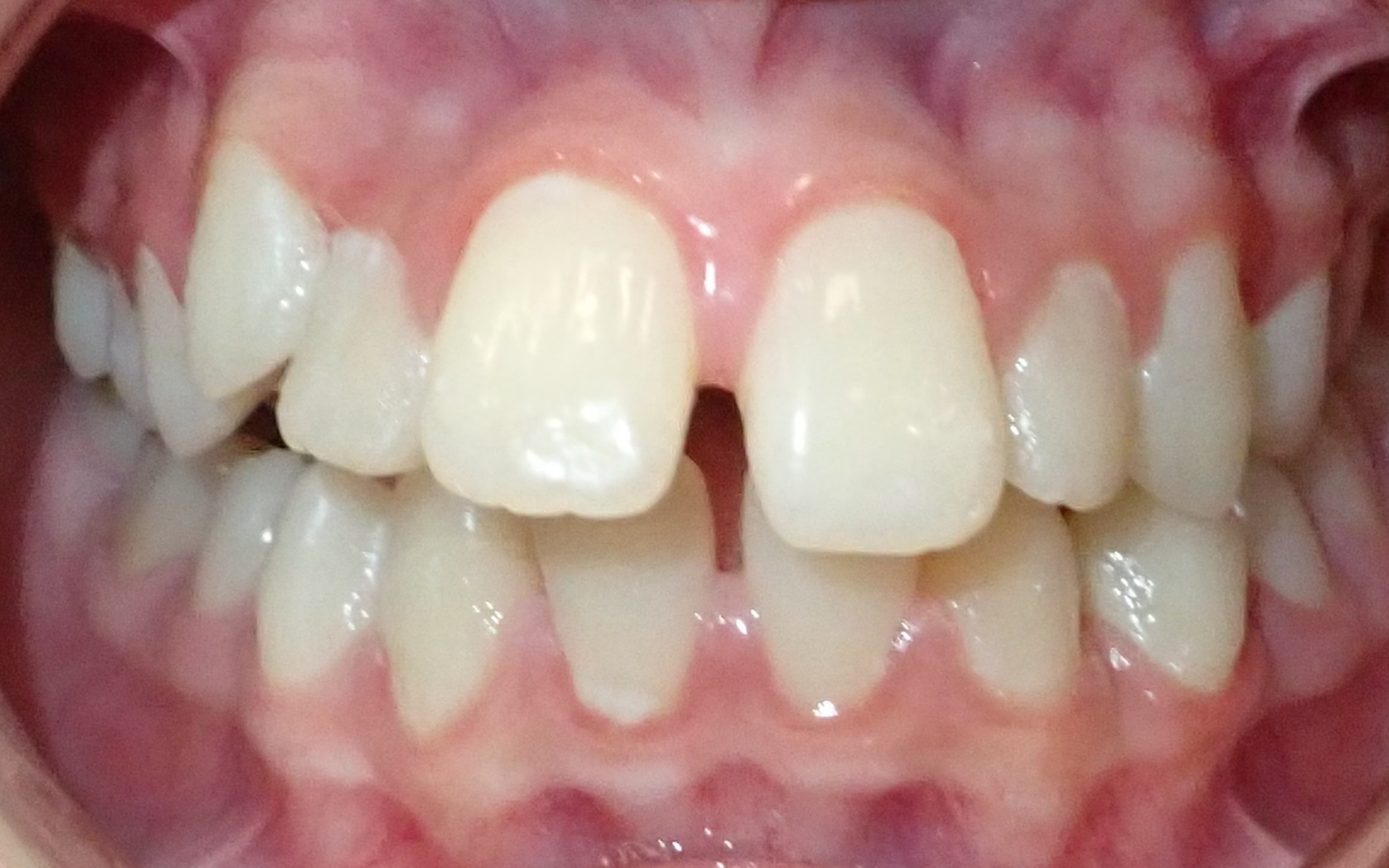 Before