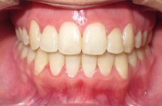 open bite after braces open bite after braces