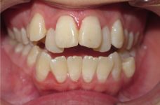 open bite before braces open bite before braces