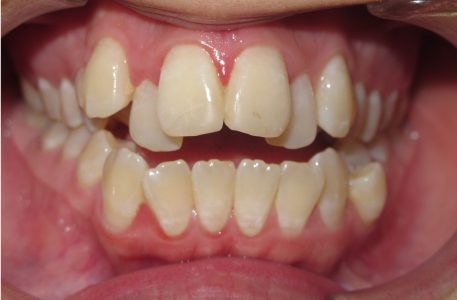 open bite before braces open bite before braces