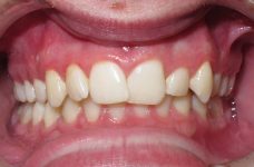 mild deep bite before braces mild deep bite before braces