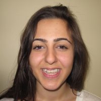 open bite before braces open bite before braces