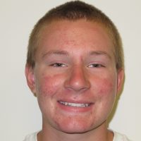 mild deep bite before braces mild deep bite before braces