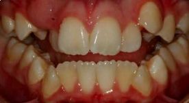 open bite before braces open bite before braces