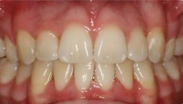 open bite after braces open bite after braces